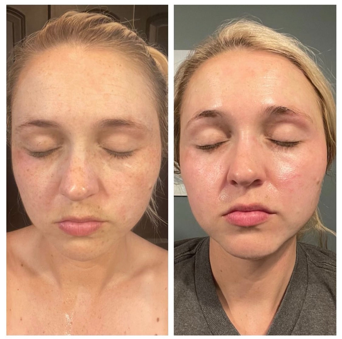 Brightening Pads with 4% Hydroquinone