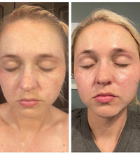 Brightening Pads with 4% Hydroquinone