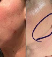 Brightening Pads with 4% Hydroquinone