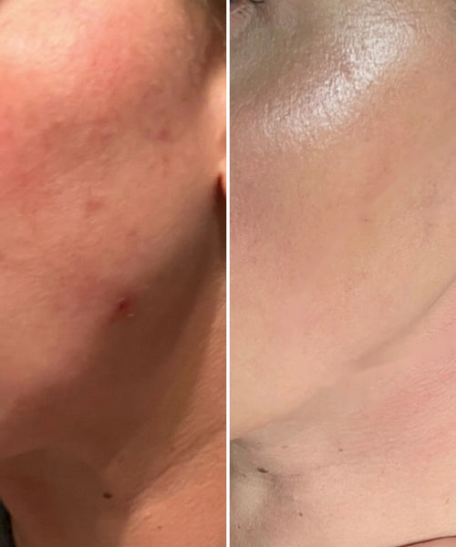 Before and after, Face Forward Brightening Pads