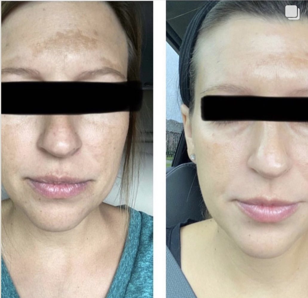 Before and after — dark spots and hyperpigmentation